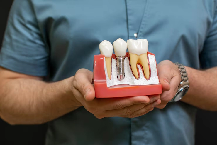 dental-implant